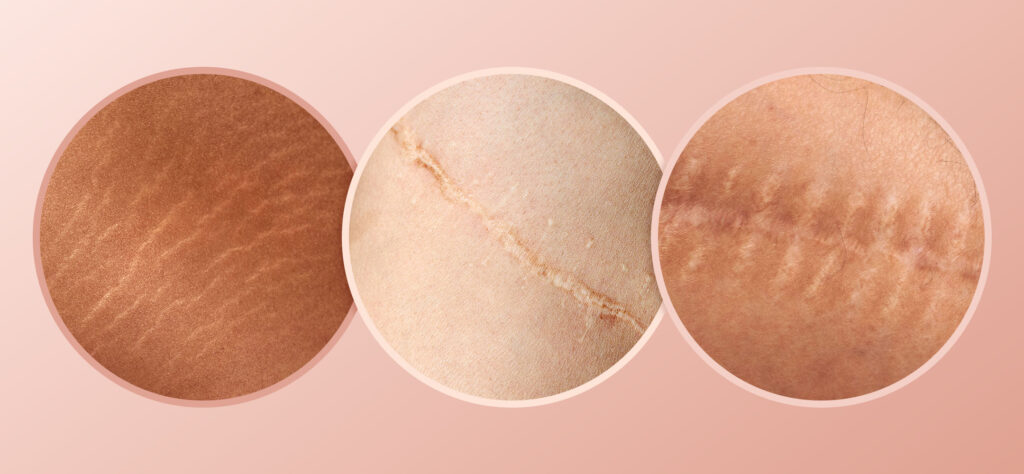 Come il camouflage cutaneo e il tatuaggio medico restituiscono fiducia dopo le cicatrici